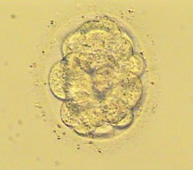 Umetna oploditev, zdravljenje neplodnosti, IVF